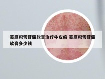芙原积雪苷霜软膏治疗牛皮癣 芙原积雪苷霜软膏多少钱