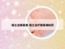 瑞士治银屑病 瑞士治疗银屑病的药