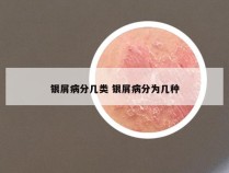 银屑病分几类 银屑病分为几种