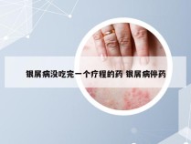 银屑病没吃完一个疗程的药 银屑病停药