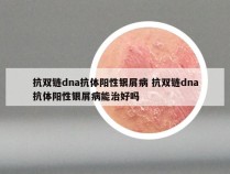 抗双链dna抗体阳性银屑病 抗双链dna抗体阳性银屑病能治好吗