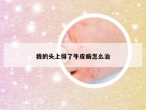 我的头上得了牛皮癣怎么治