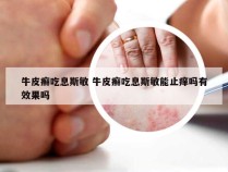 牛皮癣吃息斯敏 牛皮癣吃息斯敏能止痒吗有效果吗