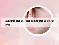 脓包型银屑病怎么消肿 脓包型银屑病怎么消肿快