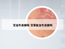 艾治牛皮癣吗 艾草能治牛皮廨吗