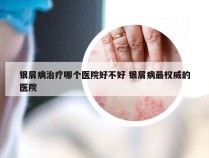 银屑病治疗哪个医院好不好 银屑病最权威的医院