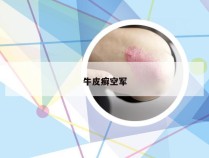 牛皮癣空军