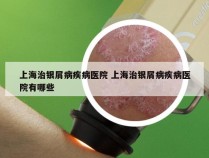 上海治银屑病疾病医院 上海治银屑病疾病医院有哪些