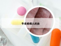 牛皮癣病人的血