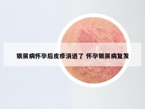 银屑病怀孕后皮疹消退了 怀孕银屑病复发