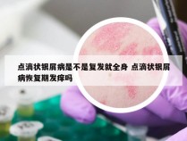 点滴状银屑病是不是复发就全身 点滴状银屑病恢复期发痒吗