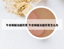 牛皮癣越治越厉害 牛皮癣越治越厉害怎么办