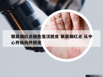 银屑病红点颜色变淡脱皮 银屑病红点 从中心开始向外脱皮