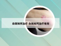 白斑如何治疗 白斑如何治疗有效