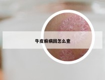 牛皮癣病因怎么查
