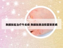 胸腺肽能治疗牛皮癣 胸腺肽肠溶胶囊银屑病