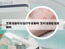 艾草泡澡可以治疗牛皮癣吗 艾叶泡澡能治皮癣吗