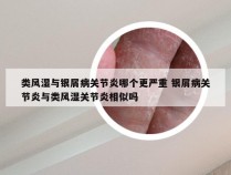 类风湿与银屑病关节炎哪个更严重 银屑病关节炎与类风湿关节炎相似吗