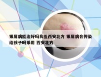 银屑病能治好吗良医西安北方 银屑病会传染给孩子吗采用 西安北方