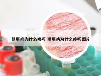 银屑病为什么疼呢 银屑病为什么疼呢图片