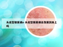 头皮型银屑病o 头皮型银屑病会发展到身上吗