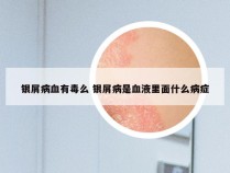 银屑病血有毒么 银屑病是血液里面什么病症