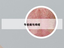 牛皮癣与痔疮