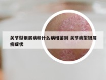 关节型银屑病和什么病相鉴别 关节病型银屑病症状