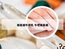 银屑病牛初乳 牛吧银屑病