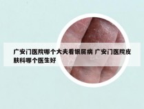广安门医院哪个大夫看银屑病 广安门医院皮肤科哪个医生好