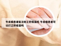 牛皮癣患者能注射乙肝疫苗吗 牛皮癣患者可以打乙肝疫苗吗