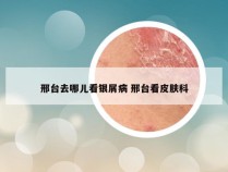 邢台去哪儿看银屑病 邢台看皮肤科