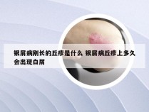 银屑病刚长的丘疹是什么 银屑病丘疹上多久会出现白屑