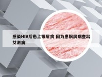 感染HIV后患上银屑病 因为患银屑病查出艾滋病