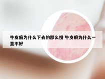 牛皮癣为什么下去的那么慢 牛皮癣为什么一直不好