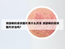 颈部癣的症状图片用什么药膏 颈部癣的症状图片好治吗?