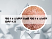 阿达木单抗治银屑病加重 阿达木单抗治疗银屑病的机理