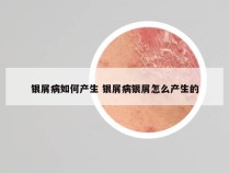 银屑病如何产生 银屑病银屑怎么产生的