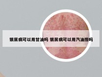 银屑病可以用甘油吗 银屑病可以用汽油擦吗