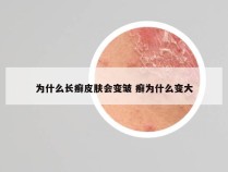 为什么长癣皮肤会变皱 癣为什么变大