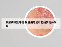 银屑病导致哮喘 银屑病可能引起的其他并发症