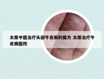 太原中医治疗头部牛皮癣的偏方 太原治疗牛皮癜医院