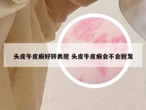头皮牛皮癣好转表现 头皮牛皮癣会不会脱发