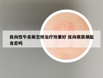 反向性牛皮癣怎样治疗效果好 反向银屑病能自愈吗