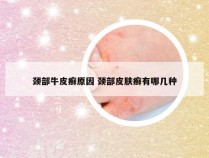 颈部牛皮癣原因 颈部皮肤癣有哪几种