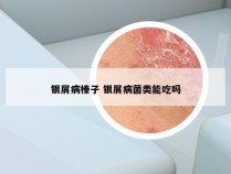银屑病榛子 银屑病菌类能吃吗