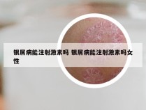 银屑病能注射激素吗 银屑病能注射激素吗女性