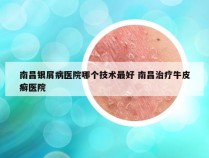 南昌银屑病医院哪个技术最好 南昌治疗牛皮癣医院