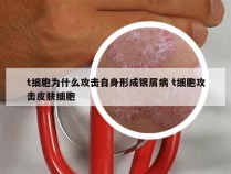 t细胞为什么攻击自身形成银屑病 t细胞攻击皮肤细胞