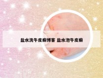 盐水洗牛皮癣博客 盐水泡牛皮癣